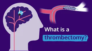 What is a thrombectomy?