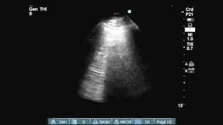 B-lines on lung ultrasound