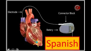 Marcapasos y otros dispositivos Cardio-Implantables