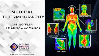 Medical Thermography using FLIR Thermal Camera