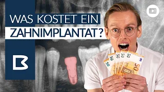 ZahnIMPLANTAT KOSTEN? Was muss ICH zahlen? Was zahlt die Krankenkasse? Alles GENAU erklärt!