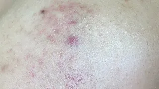 Acne Treament Under The Skin #064