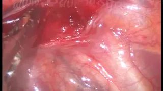 Bilateral thoracoscopic sympathectomy.