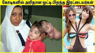 ஒட்டி பிறந்த இரட்டையர்கள் | Conjoined Twins In The World | Unbelievable Twins | TAMIL AMAZING FACTS