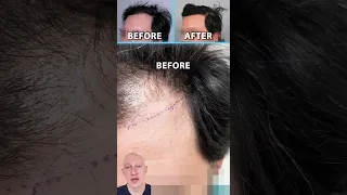 How I Got This INCREDIBLE Hair Transplant Result! #hairtransplant