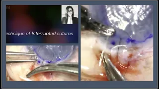 A stitch in Time .. The technique of taking Interrupted Sutures - The Essence of phaco learning