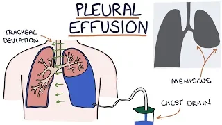 Understanding Pleural Effusions