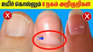 உடனே செக் பண்ணுங்க | 8 nail signs that can kill you