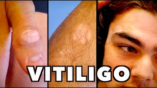 VITILIGO (Teenager With Sudden Onset of Skin Losing All Pigmentation) | Dr. Paul