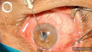 How to inject Intrastromal antifungals