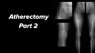 Atherectomy for Peripheral Arterial Occlusive Disease | Part 2