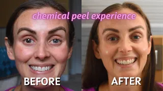 My Chemical Peel Experience | Before & After, Vlog, and Details