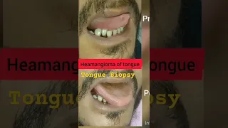 Tongue Biopsy