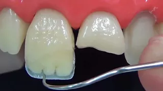 Direct restoration of the front tooth in 3 minutes | TIME LAPSE . Anterior tooth restoration