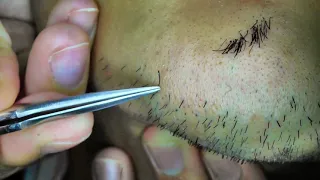 Extractions Ingrown Hair l Tweezers Beard l 2020/9/5