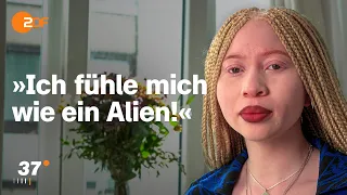 Albinismus: Luisas Kampf gegen ein Stigma I 37 Grad