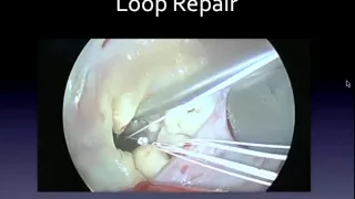 Dr Jurgen Passage: Mitral Valve Surgery Techniques