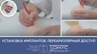 Установка имплантов. Периареолярный доступ