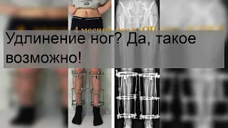 Удлинение ног? Да, такое возможно!