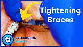 Tightening Braces | How & Why Of Changing Wires