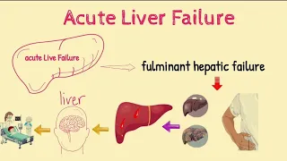 Acute Liver Failure Or Fulminant Hepatic Failure | Sign Symtoms | Causes | Risk Factors | Treatment