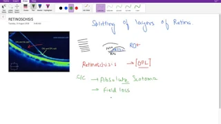 Retinoschisis