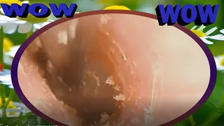 THE BIGGEST PIECE OF EAR WAX REMOVED...EVER! .ear wax removal EP#375