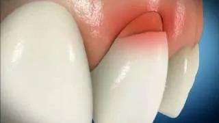 Bonding   Tooth Brush Abrasion Repair