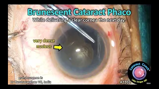 CataractCoach™ 2202: brunescent cataract phaco with a clear cornea the next day