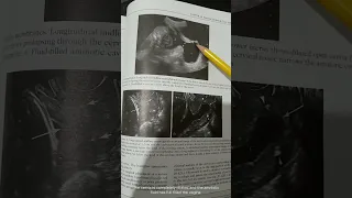Ultrasound of cervix ( from the book Requisite of Ultrasound)