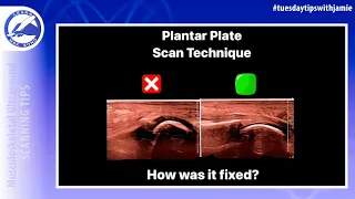 Technical tips for scanning the plantar plates of the toes on MSK ultrasound exam of the forefoot