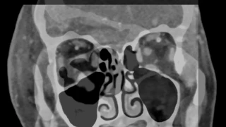 Periorbital Cellulitis