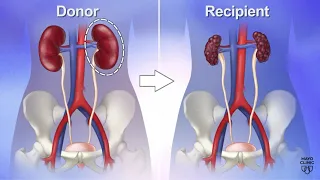 Mayo Clinic Minute: Reasons to be a living kidney donor