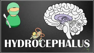 Hydrocephalus - Causes, Types, Signs and Symptoms, Pathophysiology, Diagnosis and Treatment