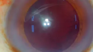 Cataract in India Brown black cataract Live surgery from Nandadeep Eye Hospital