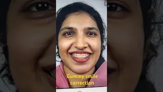 Best gummy smile correction - before and after video