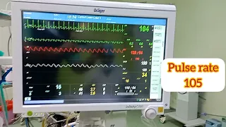 ICU Monitor Read...  Heart rate,  Pulse rate,  B. P. & Etco2  , Oxygen saturation (Spo2) ,
