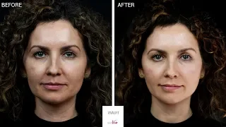 A non-surgical face lift | Explained | Before & After