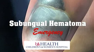 Subungual Hematoma Emergency and Trephination Procedure