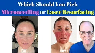 Should You Get Microneedling or Laser Resurfacing? | Plastic Surgeon's Advice