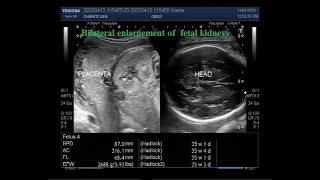 Bilateral enlargement of fetal kidneys with Pregnancy of about 35 weeks.