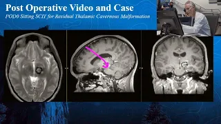 Episode 6: Residual Thalamic Cavernous Malformation