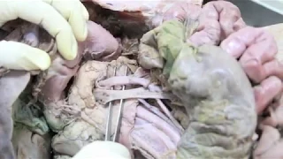 Anatomy Dissection of Pancreas & Duodenum