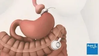 How gastric banding surgery is carried out