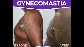 Look at these amazing #gynecomastia results!