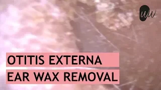 Ear Wax Removal of both Ears in Client with Otitis Externa - #360