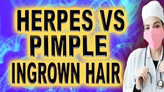 herpes vs pimple ingrown hair