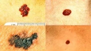 What Does Melanoma Look Like? | Skin Cancer