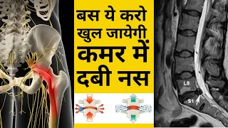 बस ये करो ठीक हो जाएगी कमर में दबी नस | L4-L5 disc Bulge | SCIATICA | DABI NAS | leg pain | Hip pain