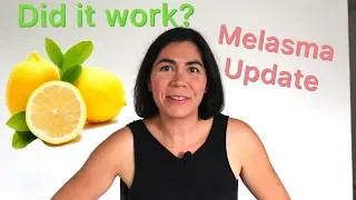 Does lemon juice work ? Melasma Challenge Update ( 2019 )